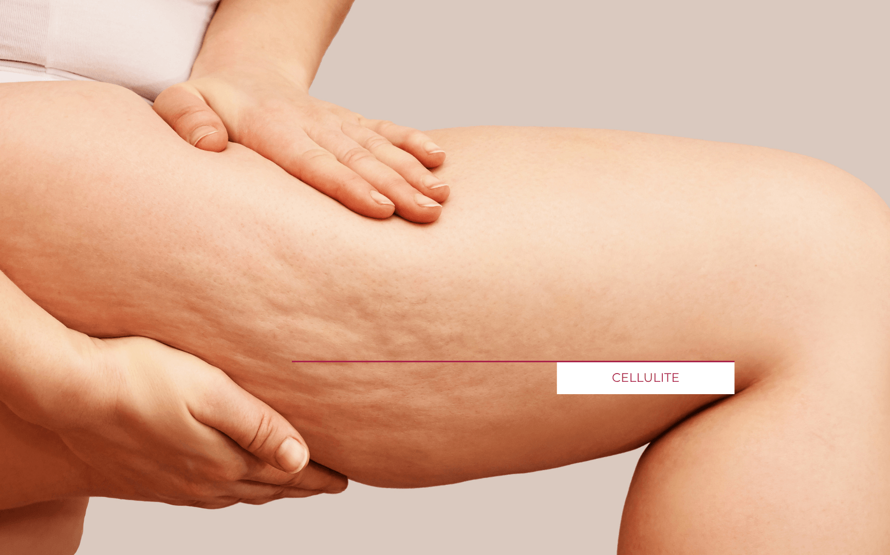 Oberschenkel einer Frau mit Cellulite