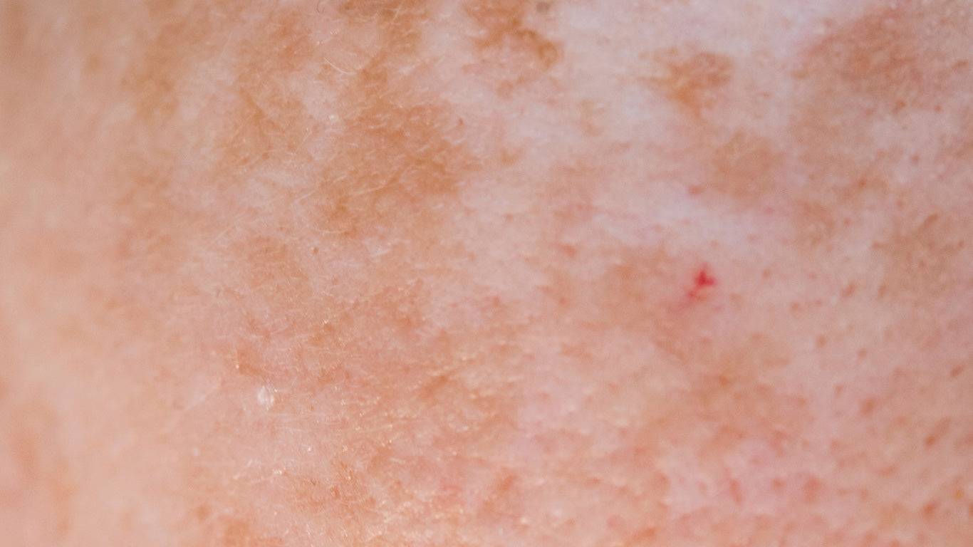 Hautpartie mit empfindlicher Haut