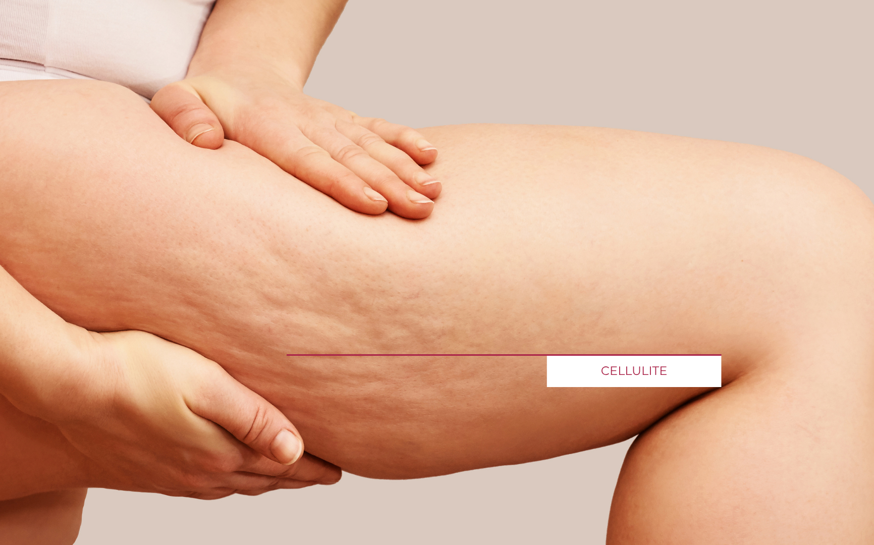 Frau hält Oberschenkel mit sichtbarer Cellulite und Dellenbildung in der Haut