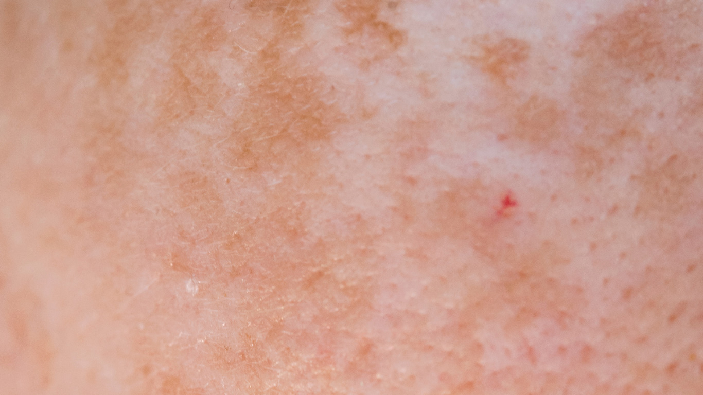 Nahaufnahme empfindlicher Haut mit unruhigem Hautbild und vereinzelten Pigmentveränderungen
