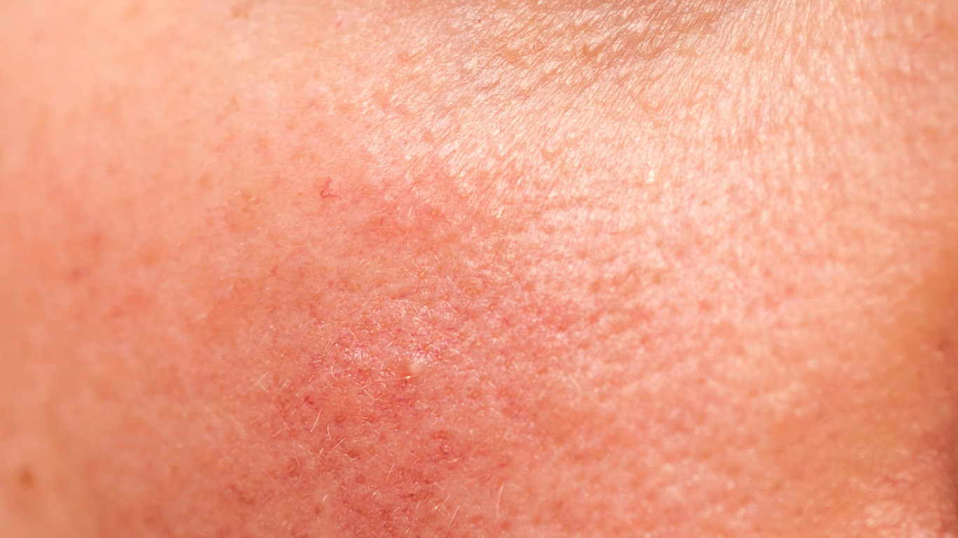 Detailaufnahme von Mischhaut mit trockenen Bereichen und sichtbaren Rötungen